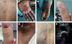 Monkeypox-TheLancet.jpg