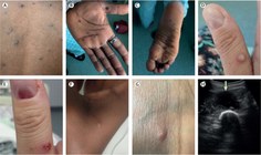 Monkeypox-TheLancet.jpg